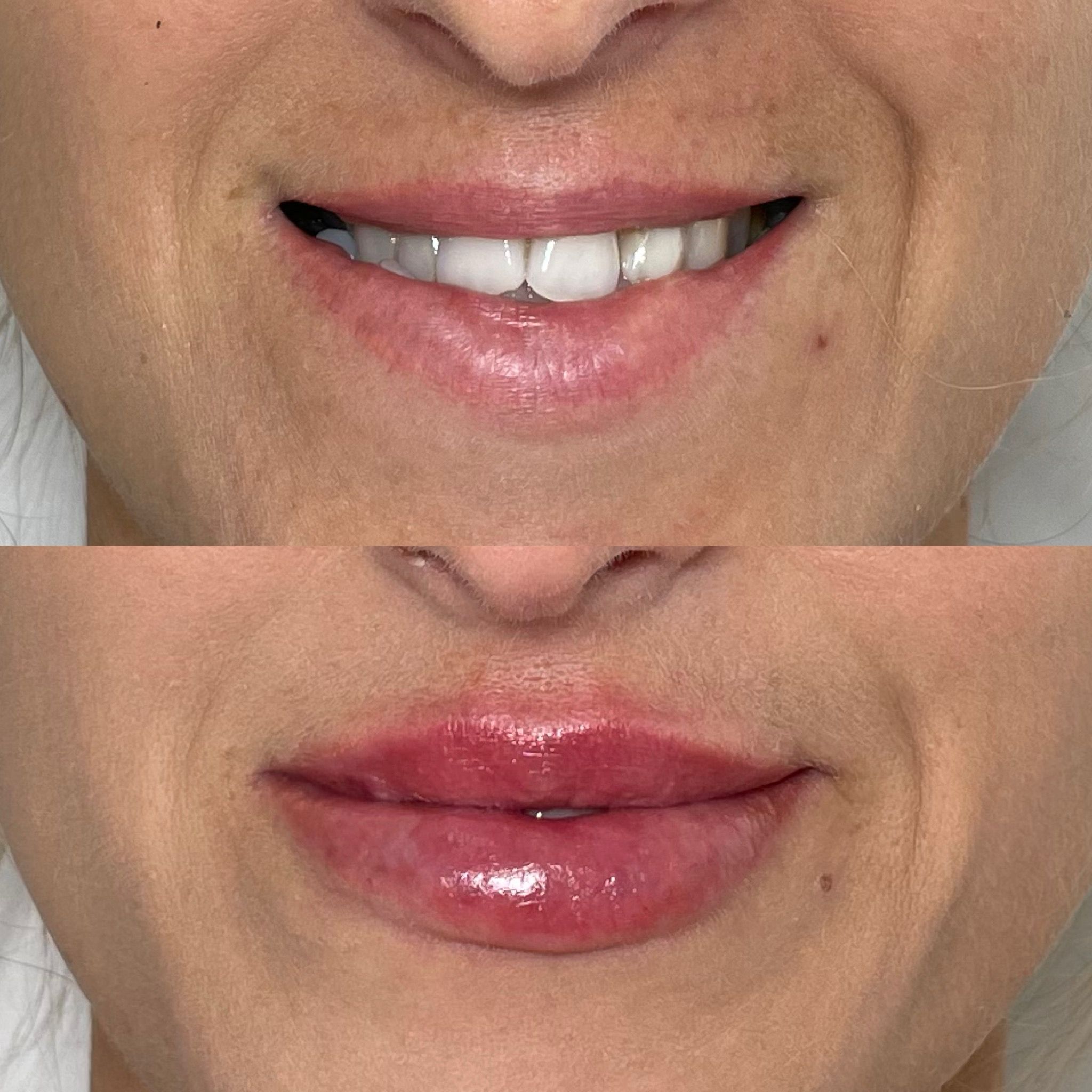 Lip Fillers, Botox, Dermal Fillers, Anti-Wrinkle Injections in Clerkenwell EC1